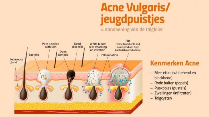 uitstulping Lichaam Rodeo HOE ONTSTAAT ACNE?